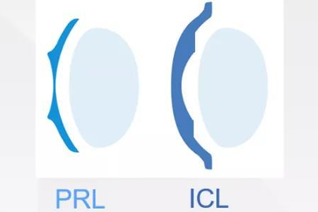 PRL晶體植入與ICL晶體植的區(qū)別體現(xiàn)